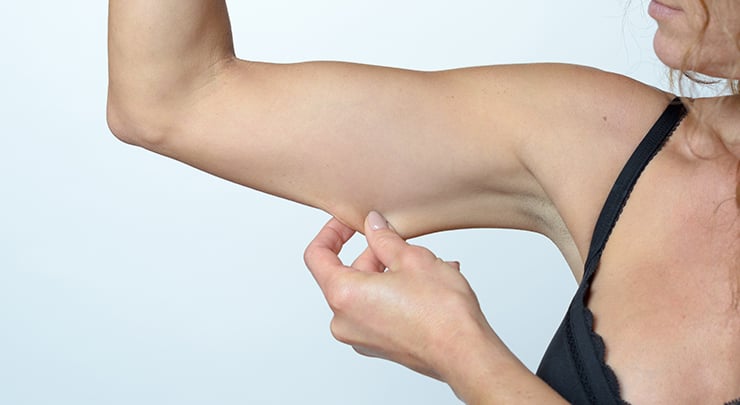 Woman pinching the saggy skin on her upper arms before an arm lift.