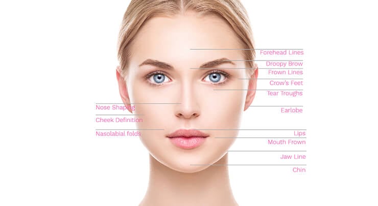 Diagram showing the areas that can be treated with injectable fillers on the female face.