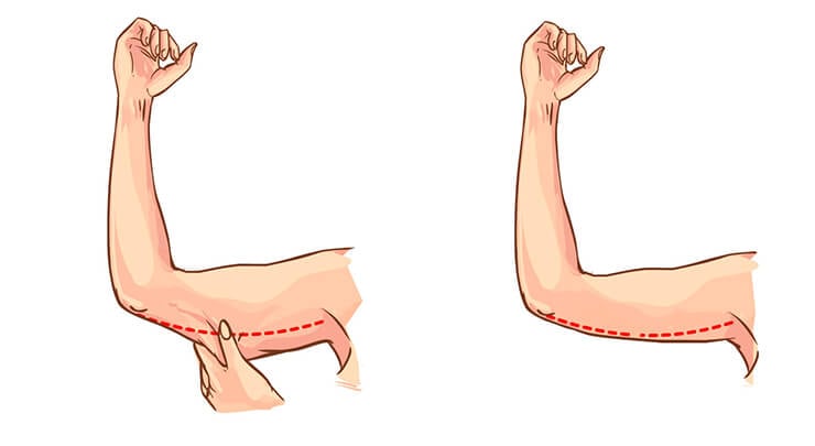 Diagram of armlift or brachioplasty, showing incision location and removal of excess tissue.