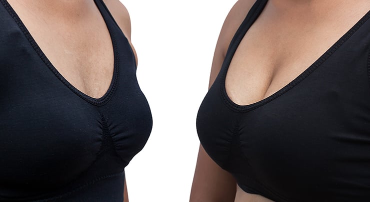 Woman before and after augmentation mastopexy wearing a black bra