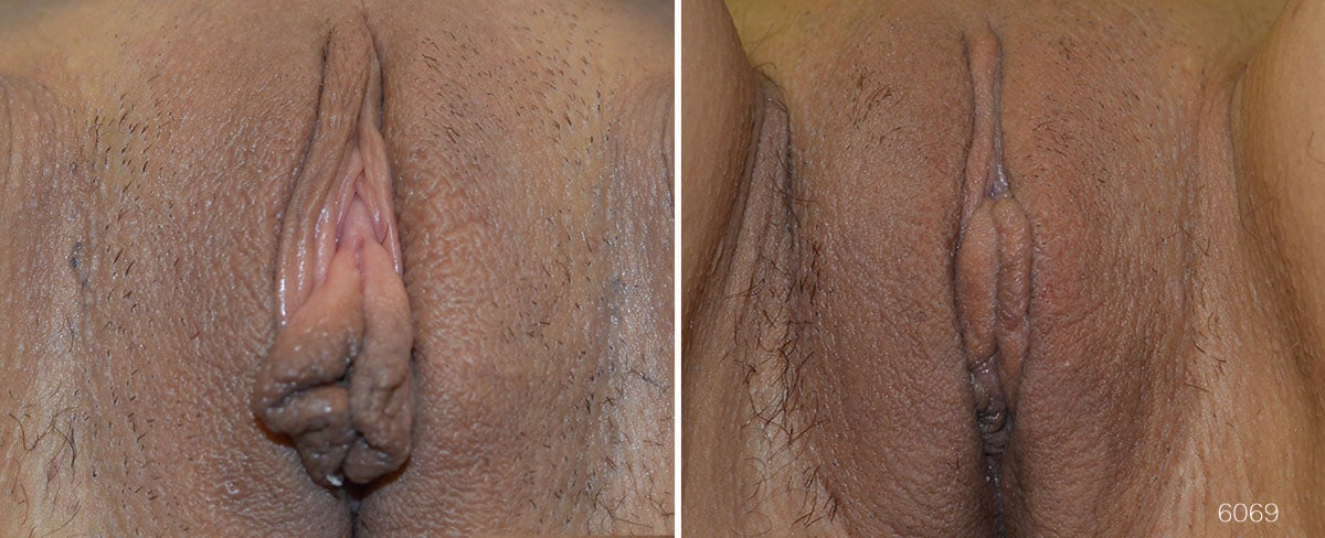 Before and after pictures of woman who has had labiaplasty.