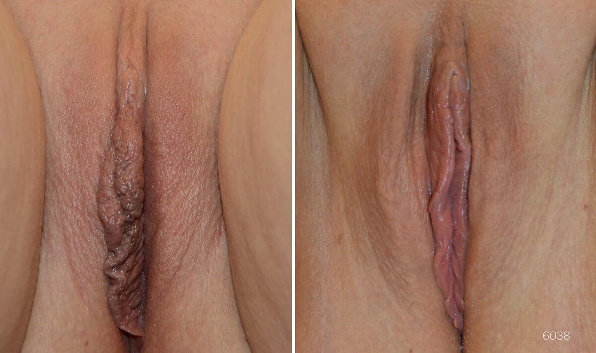 Before and after pictures of woman who has had labiaplasty.