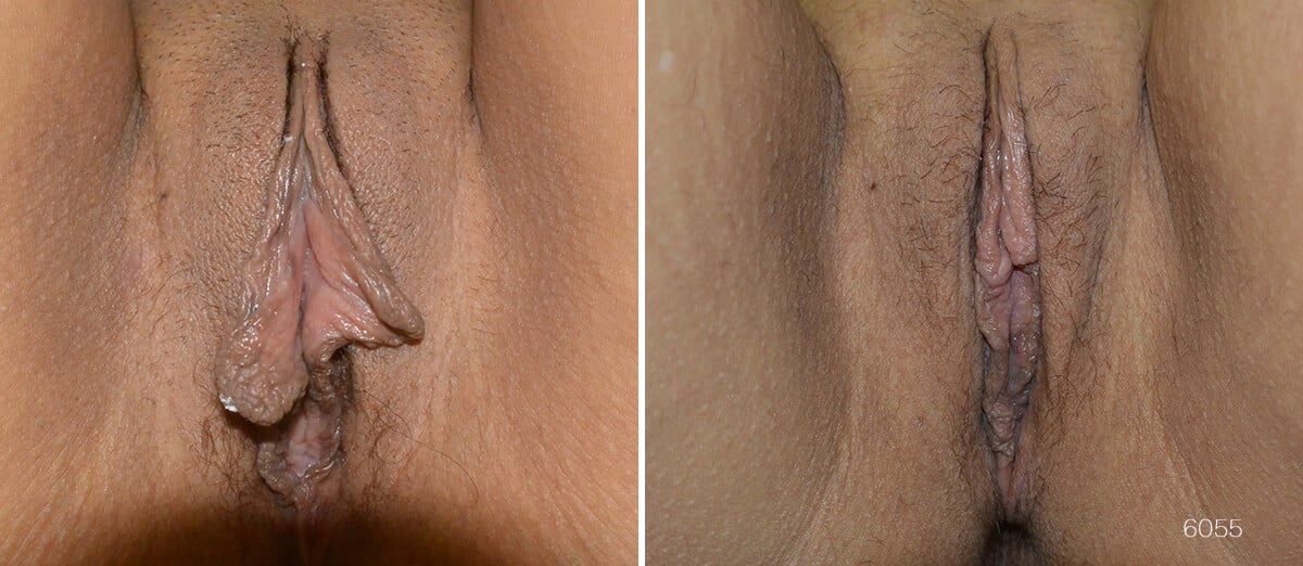 Before and after pictures of woman who has had labiaplasty.