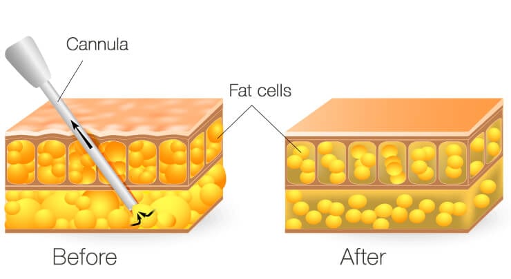 Cross section of subcutaneous fat layers showing removal of fat cells with liposuction, before and after treatment.