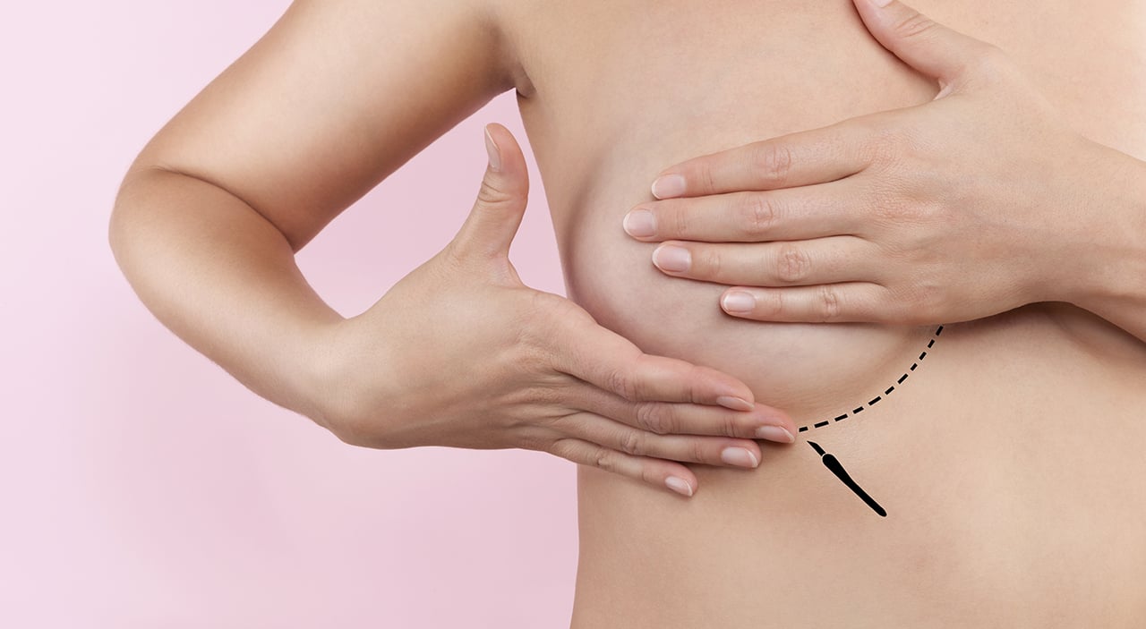 Woman covering her breast with markings of where to place incision during breast augmentation.