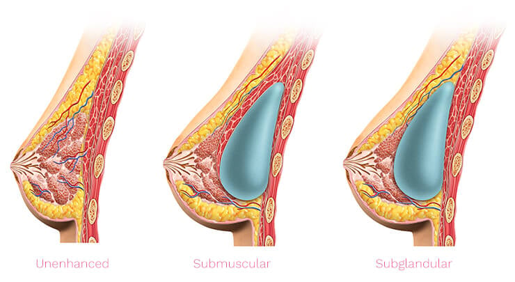 Diagram showing a natural breast, the placement of a breast implant in subglandular position and in the submuscular position.