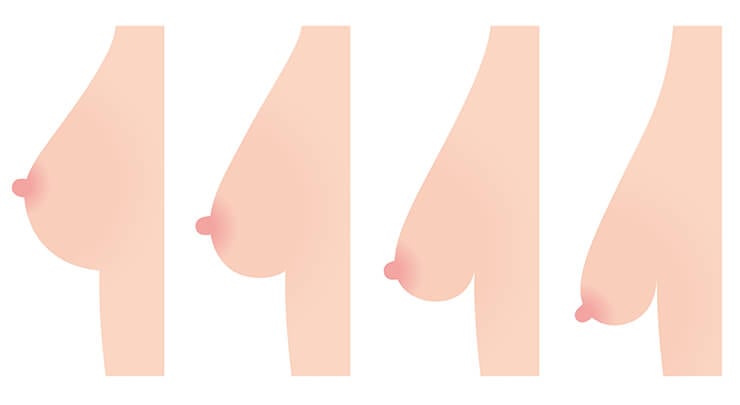 Diagram showing the varying degress of breast ptosis, or sagging.