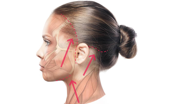 Diagram showing incision placement for a facelift and the direction of tissue removal.