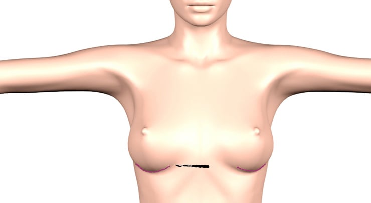 Inframammary incision placement for breast augmentation.