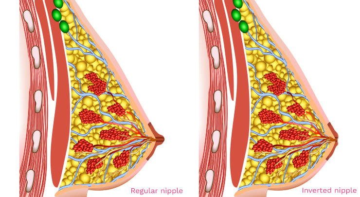 Female breast diagram showing regular nipple and inverted nipple.