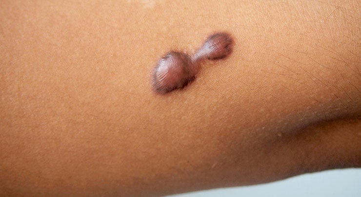 Keloid scar on arm.