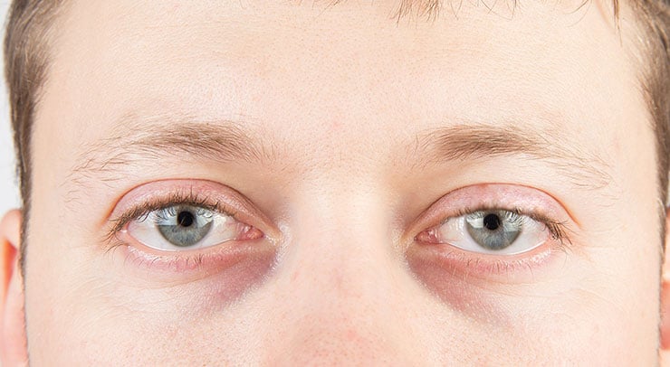 Close up of a man's eyes and droopy eyelid.