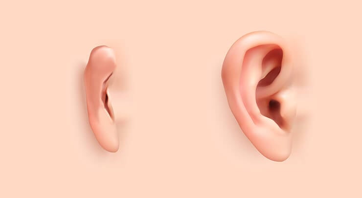 Diagram showing an ear affected by microtia and a normal ear.