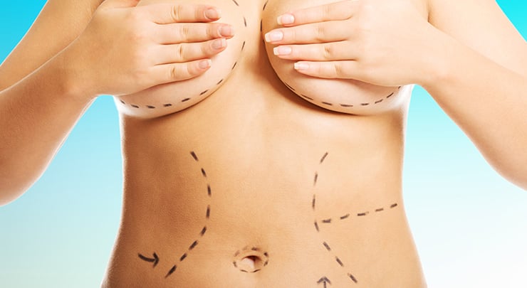 Woman with plastic surgery markings to show what areas will be treated during her mommy makeover.