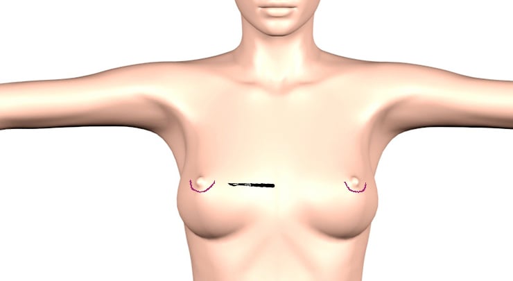 Periareolar incision placement for breast augmentation.