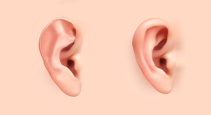 Diagram showing an ear affected by stahls bar and a normal ear.