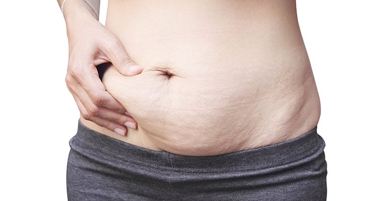 Woman pinching her stomach that has stretchmarks and loose skin after pregnancy.