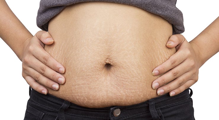 Woman showing stretchmarks on her post pregnancy stomach.
