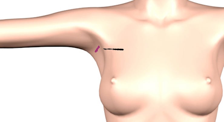 Transaxillary incision placement for breast augmentation.