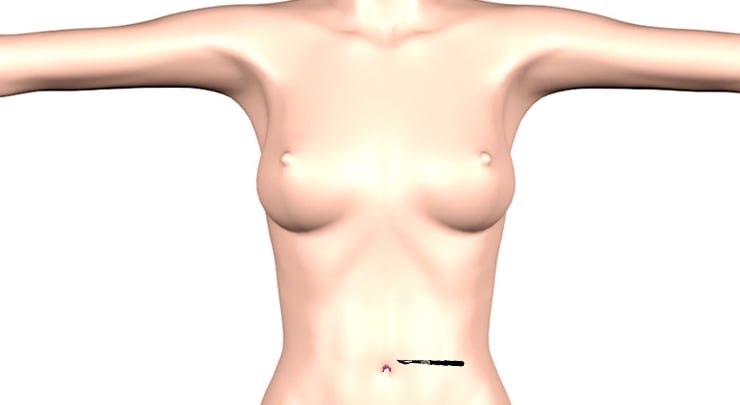 Transumbilical incision placement for breast augmentation.