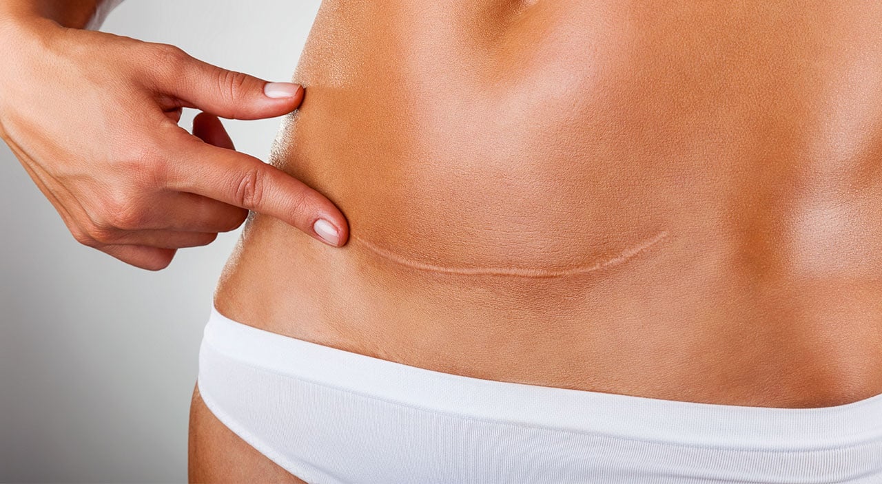 Woman pointing at her scar after a mini tummy tuck.