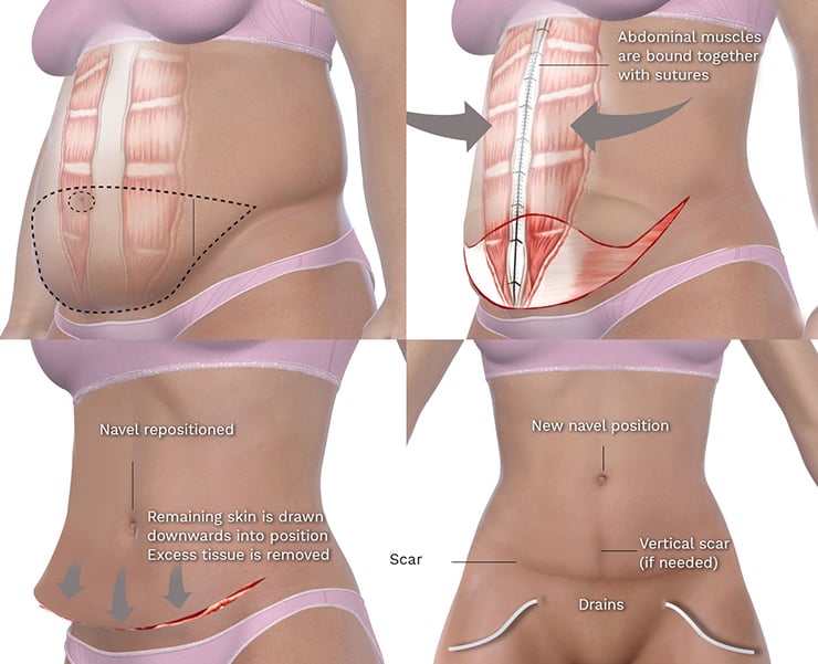 Diagrama das etapas da abdominoplastia mostrando a remoção do excesso de tecido, reposicionamento do umbigo e contração muscular pelo cirurgião plástico de Toronto.