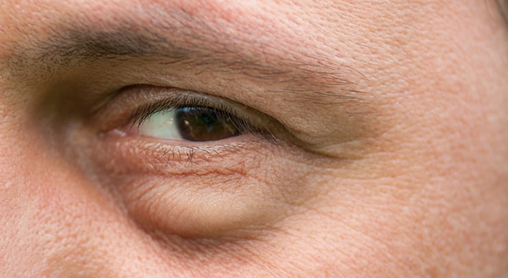 Close up of man's eyes with bags underneath.