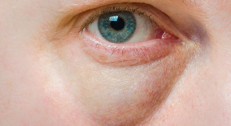 Close up of a man with puffy under eye bags.